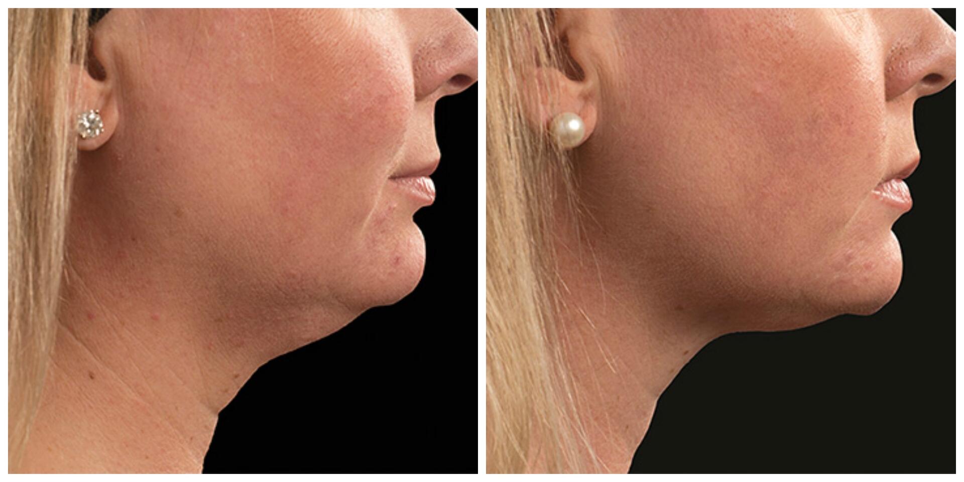 Before and After Image: CoolSculpting - right-side