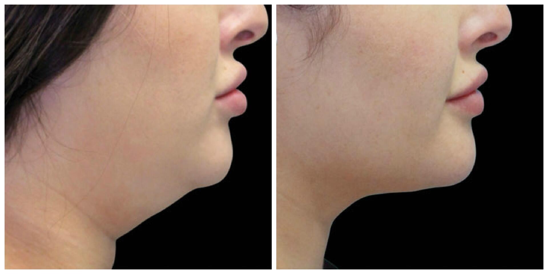 Before and After Image: CoolSculpting - right-side