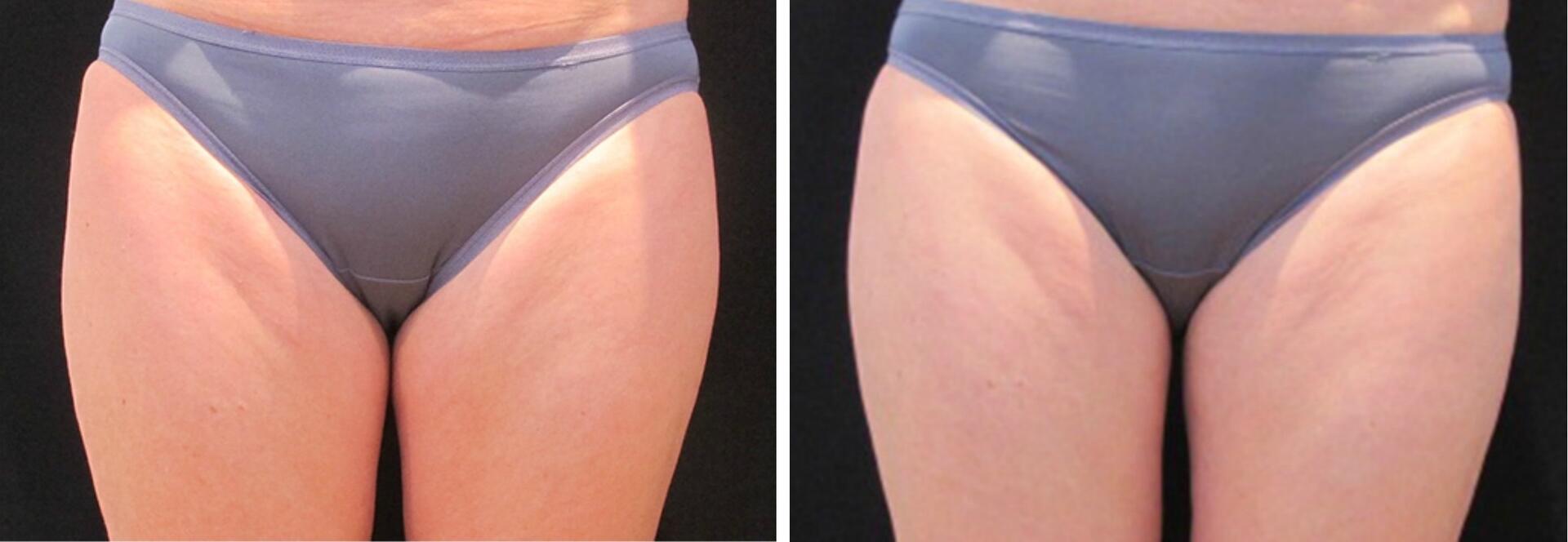 Before and After Image: CoolSculpting - front