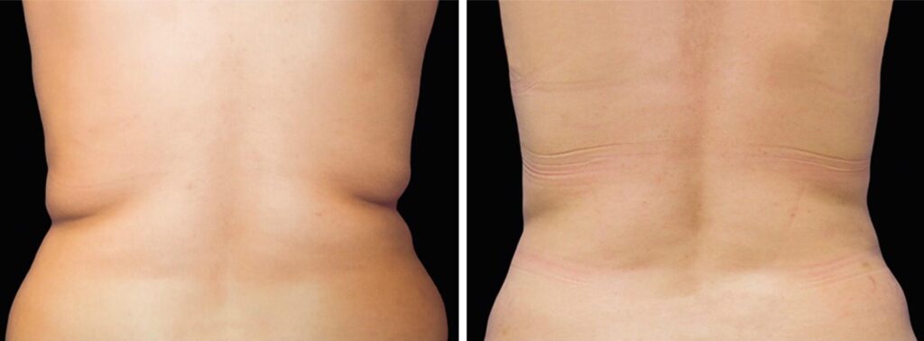 Before and After Image: CoolSculpting - back