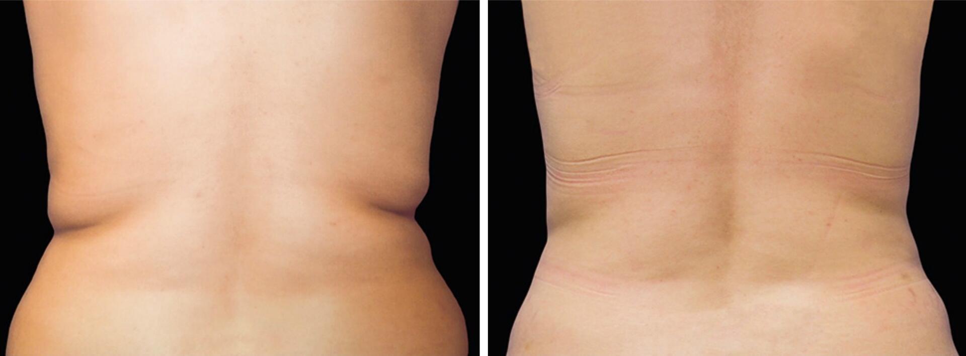 Before and After Image: CoolSculpting - back