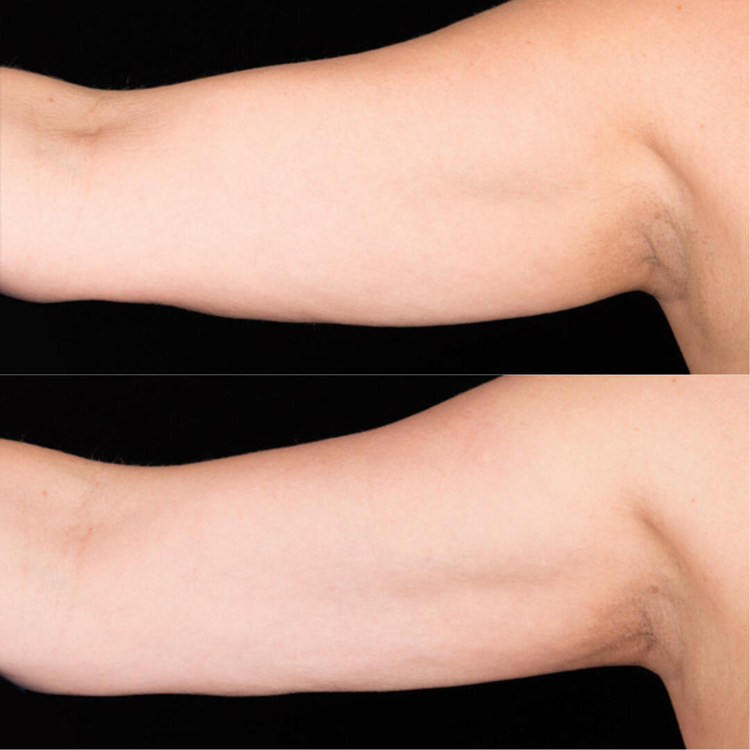 Before and After Image: CoolSculpting - front