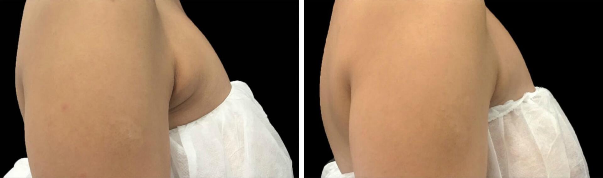 Before and After Image: CoolSculpting - right-side