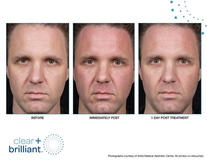 Before and After Image: Clear + Brilliant - front