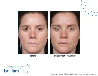 Before and After Image: Clear + Brilliant - front