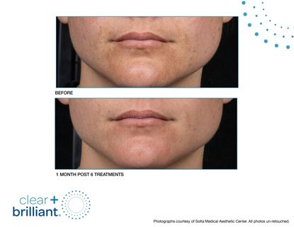 Before and After Image: Clear + Brilliant - front