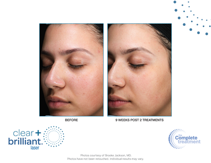Before and After Image: Clear + Brilliant - left-front-oblique