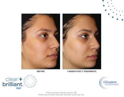 Before and After Image: Clear + Brilliant - right-front-oblique