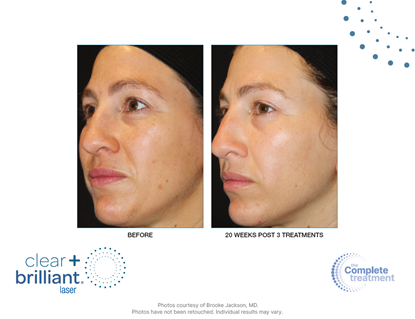 Before and After Image: Clear + Brilliant - left-front-oblique