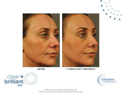 Before and After Image: Clear + Brilliant - right-front-oblique