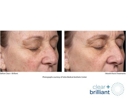Before and After Image: Clear + Brilliant - right-front-oblique