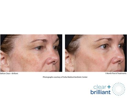 Before and After Image: Clear + Brilliant - right-front-oblique