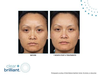 Before and After Image: Clear + Brilliant - front