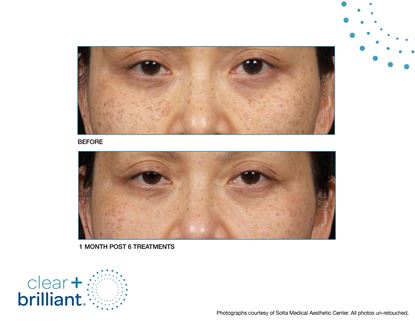 Before and After Image: Clear + Brilliant - front