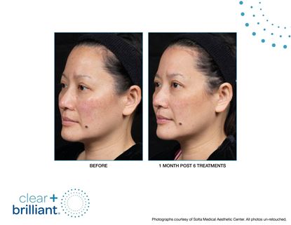 Before and After Image: Clear + Brilliant - left-front-oblique