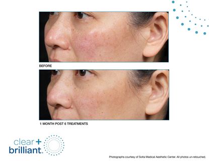 Before and After Image: Clear + Brilliant - left-front-oblique