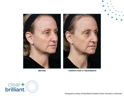 Before and After Image: Clear + Brilliant - right-front-oblique