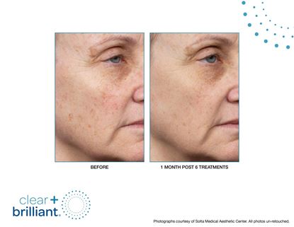 Before and After Image: Clear + Brilliant - right-front-oblique