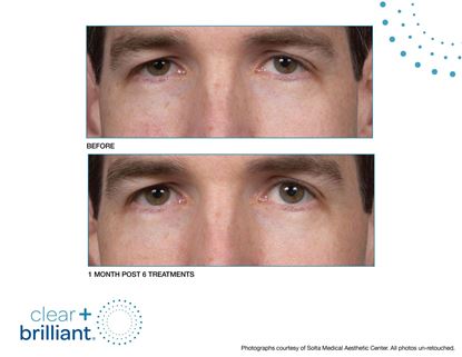 Before and After Image: Clear + Brilliant - front