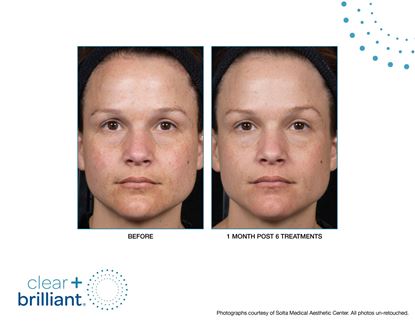 Before and After Image: Clear + Brilliant - front