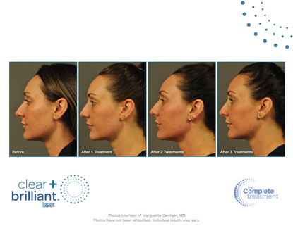 Before and After Image: Clear + Brilliant - front