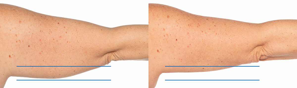 Before and After Image: CoolSculpting - back