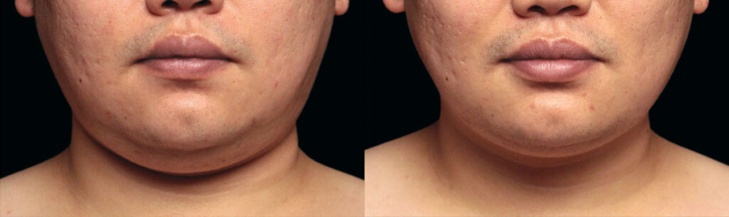 Before and After Image: CoolSculpting - front