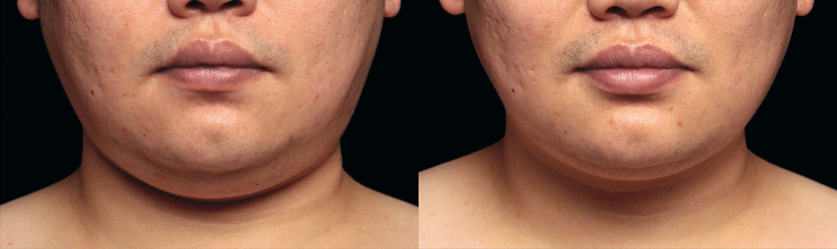 Before and After Image: CoolSculpting - front
