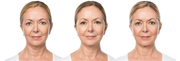 Before and After Image: Deoxycholic Acid Facial Injections - front