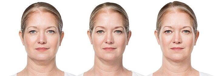 Before and After Image: Deoxycholic Acid Facial Injections - front
