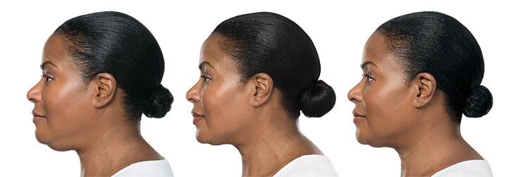 Before and After Image: Deoxycholic Acid Facial Injections - left-side