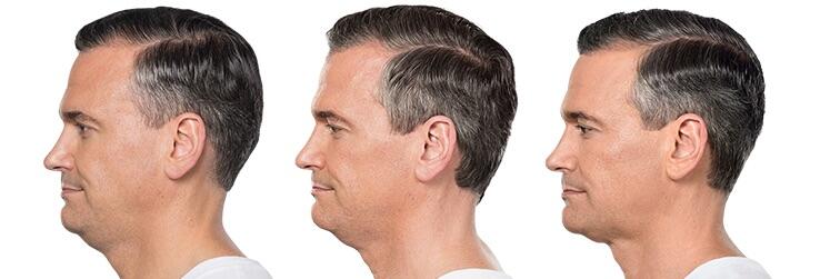 Before and After Image: Deoxycholic Acid Facial Injections - left-side