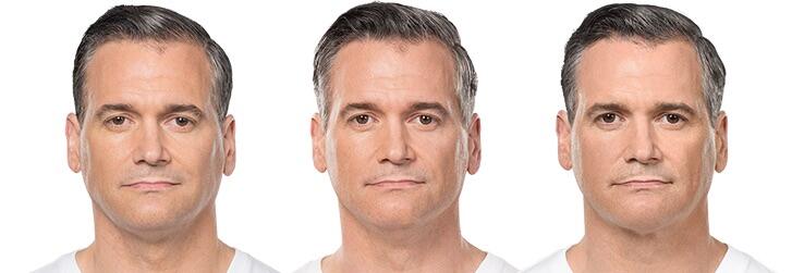 Before and After Image: Deoxycholic Acid Facial Injections - front