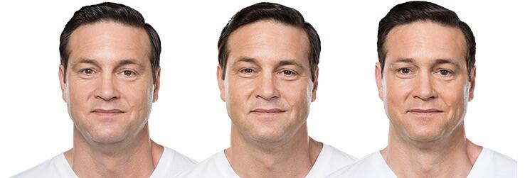 Before and After Image: Deoxycholic Acid Facial Injections - front