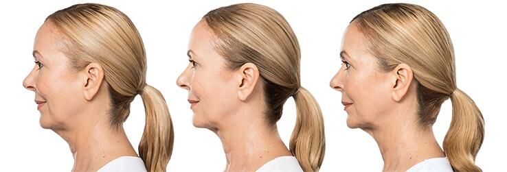 Before and After Image: Deoxycholic Acid Facial Injections - left-side