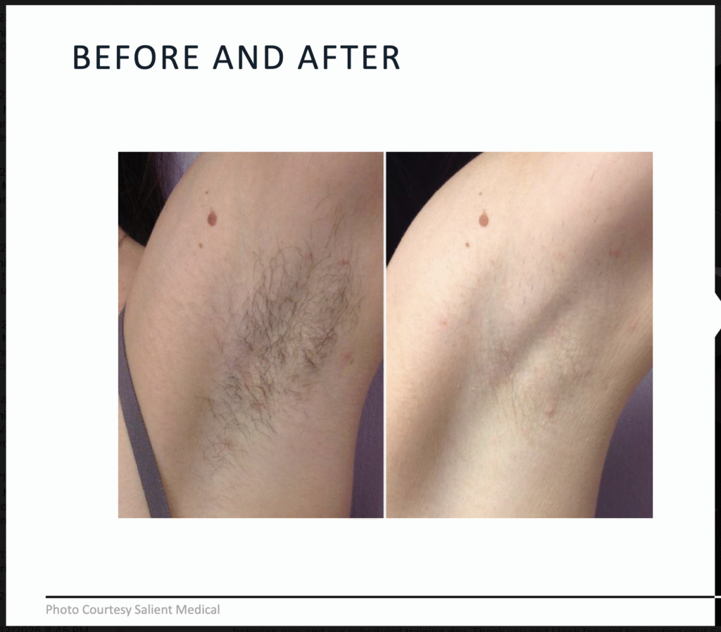 Before and After Image: Diolaze – Laser Hair Removal - front