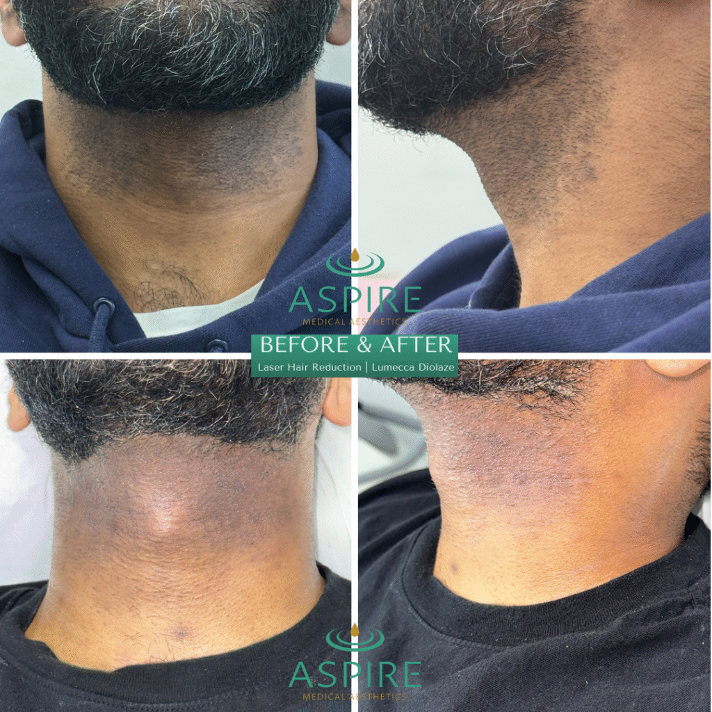 Before and After Image: Diolaze – Laser Hair Removal - front