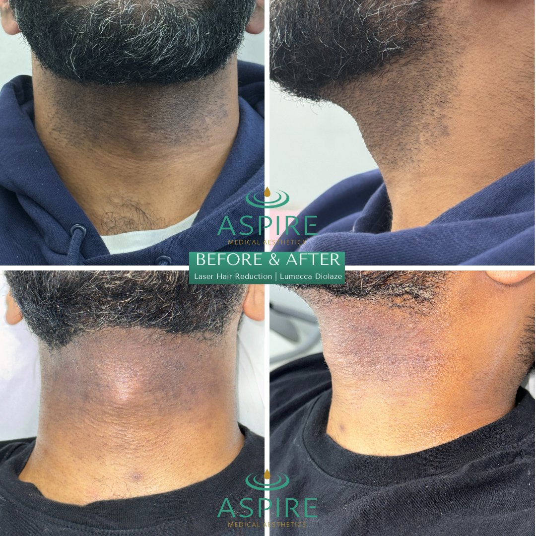 Before and After Image: Diolaze – Laser Hair Removal - front