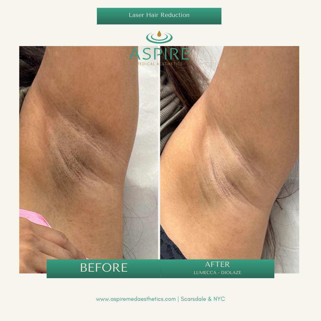 Before and After Image: Diolaze – Laser Hair Removal - front