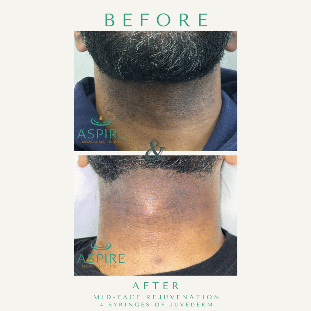 Before and After Image: Diolaze – Laser Hair Removal - front