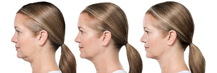 Before and After Image: Deoxycholic Acid Facial Injections - left-side
