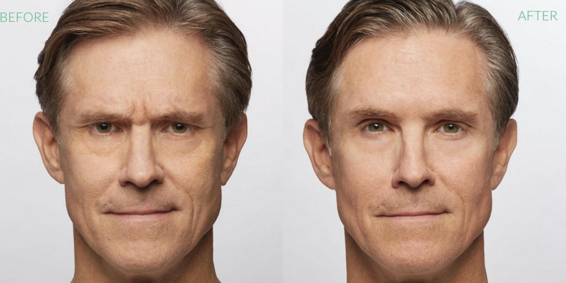 Before and After Image: Dysport - front