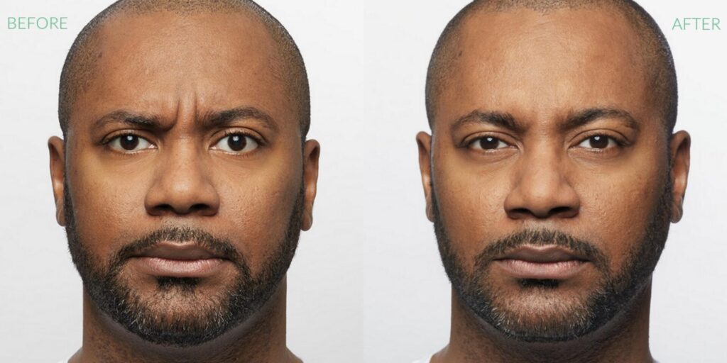 Before and After Image: Dysport - front