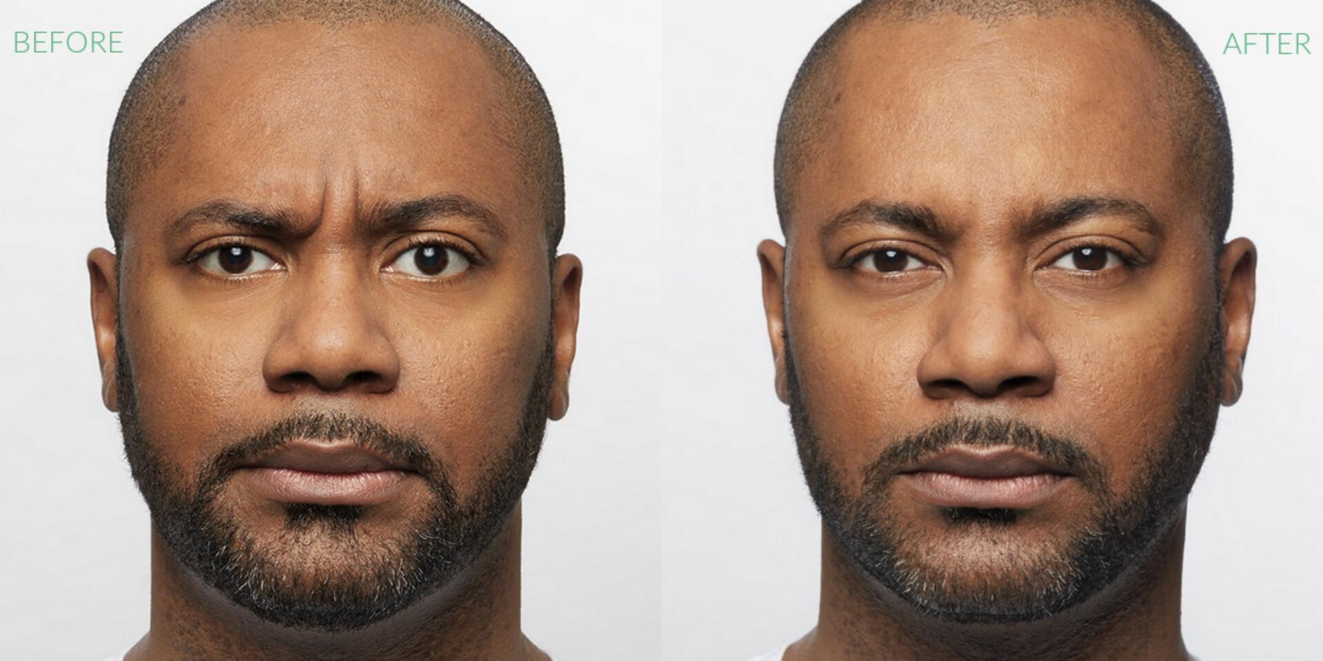 Before and After Image: Dysport - front