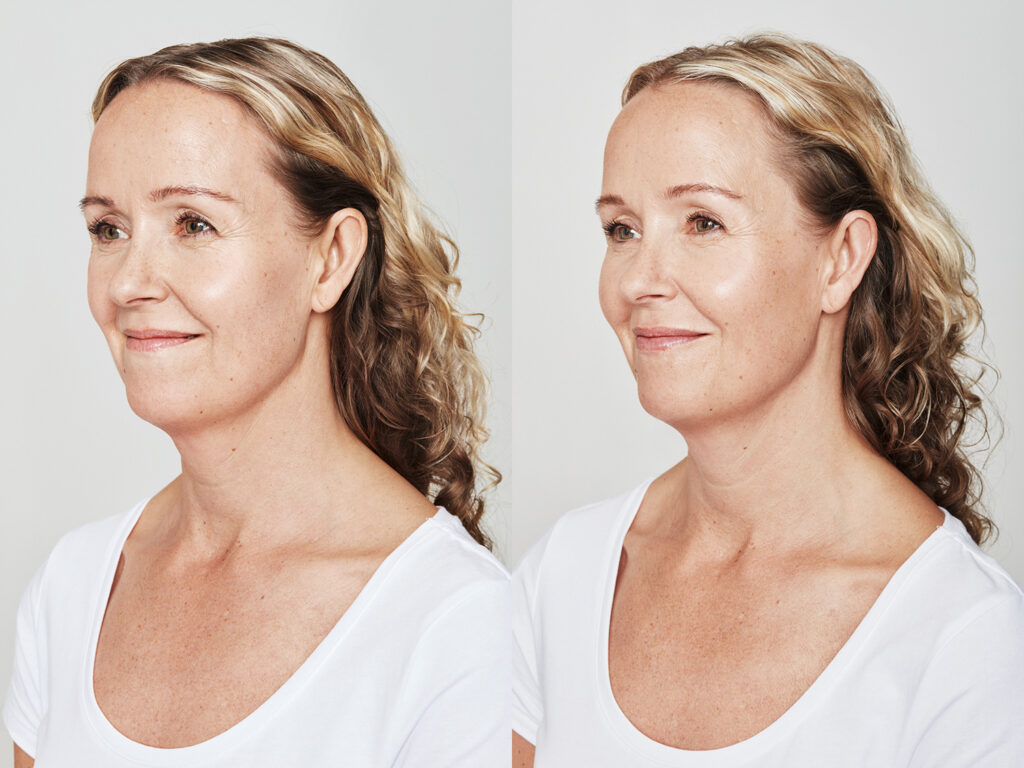 Before and After Image: Dysport - left-front-oblique