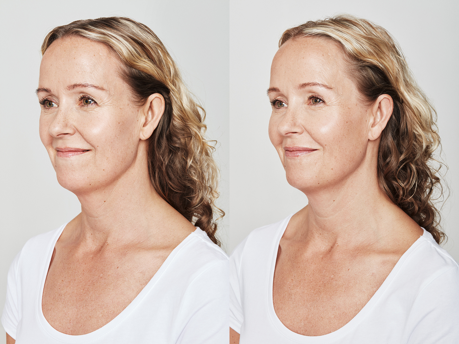 Before and After Image: Dysport - left-front-oblique