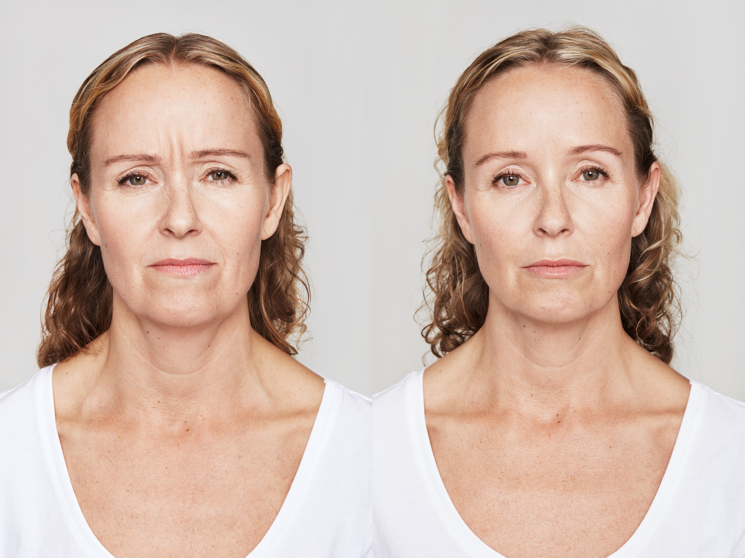 Before and After Image: Dysport - front