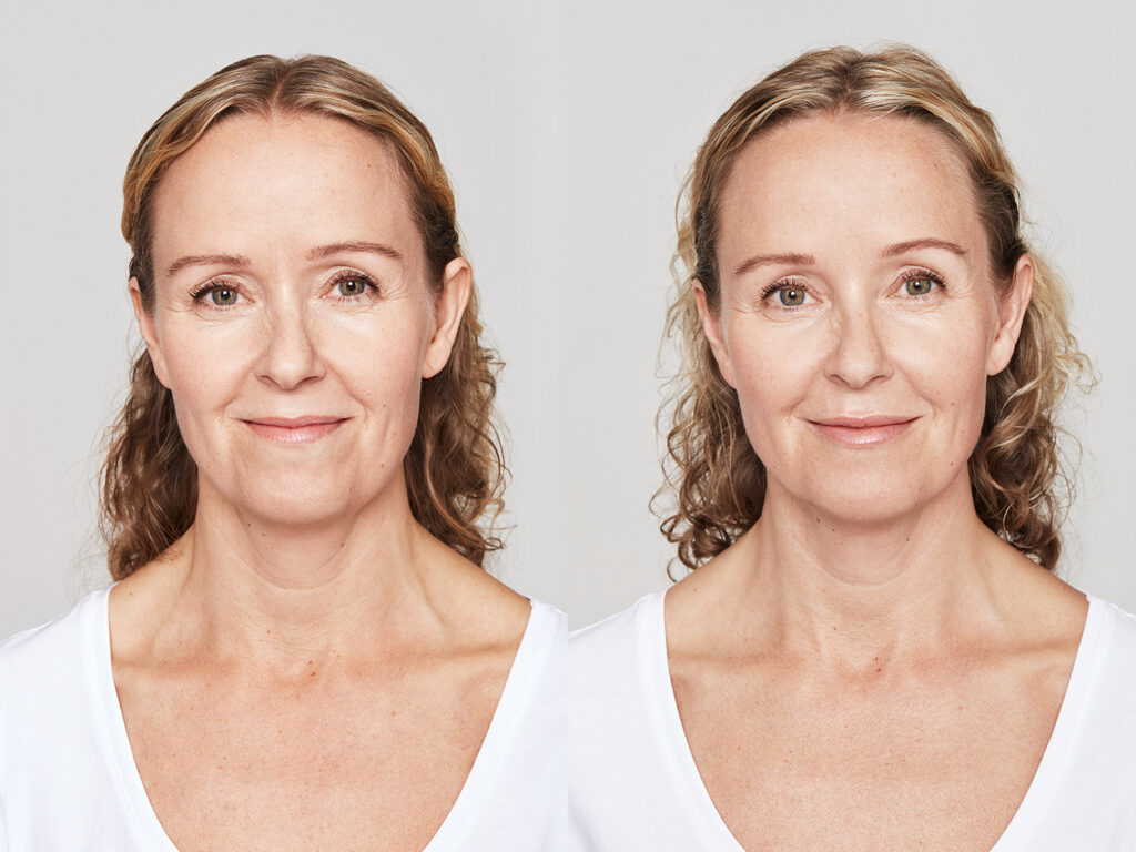 Before and After Image: Dysport - front