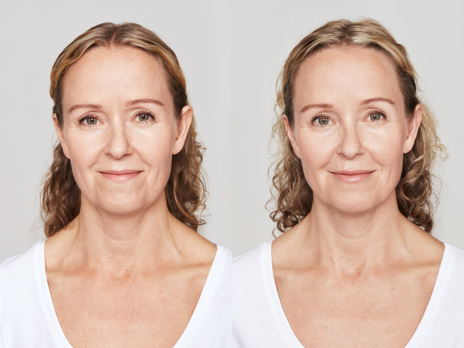 Before and After Image: Dysport - front