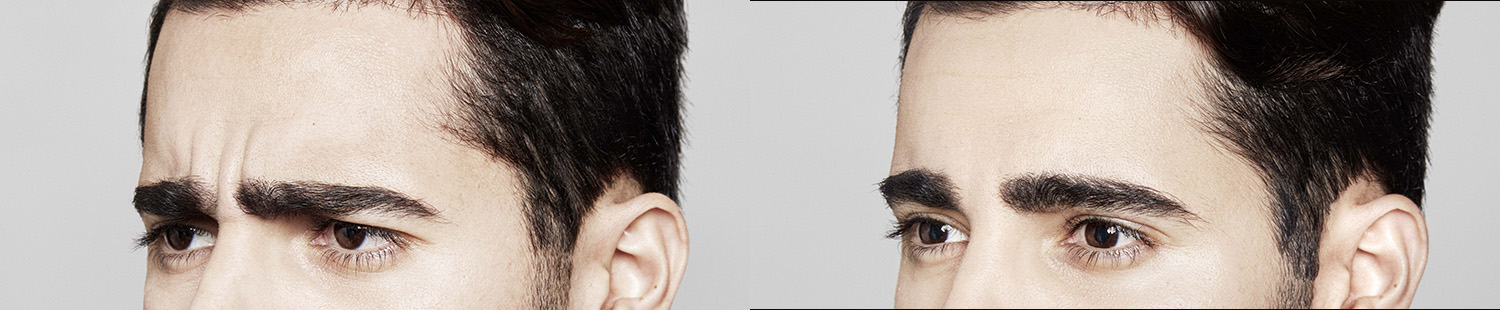 Before and After Image: Dysport - left-front-oblique